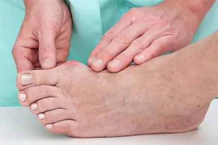 Callus &#8211; types, treatment