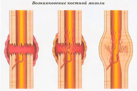 Callus - types, treatment