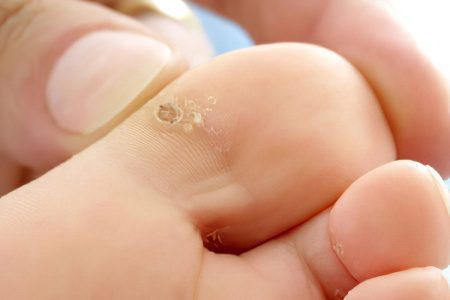 Callus on the toe &#8211; causes and methods of treatment