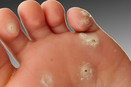 Callus on the toe - causes and methods of treatment