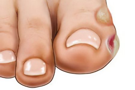 Callus on the toe - causes and methods of treatment