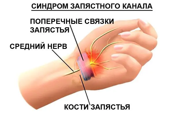 Carpal Tunnel Syndrome (Tunnel Syndrome)