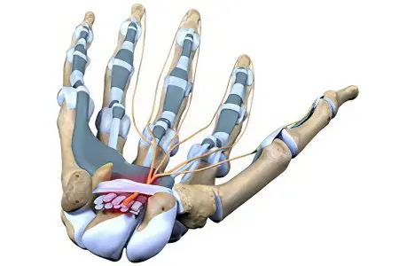 Carpal Tunnel Syndrome (Tunnel Syndrome)