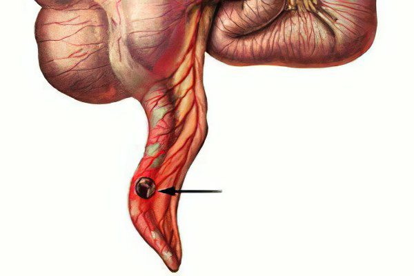 catarrhal appendicitis