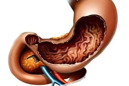 Catarrhal gastroduodenitis