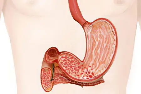 Catarrhal gastroduodenitis