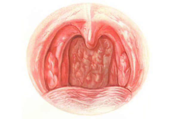 catarrhal pharyngitis