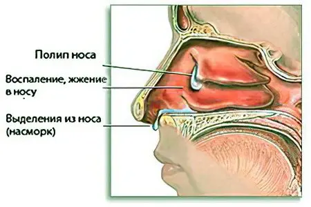 Causes and symptoms of a runny nose, how to treat?