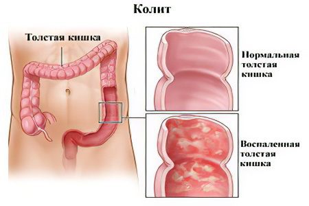 Causes and symptoms of acute and chronic intestinal colitis