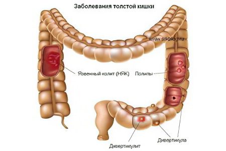 Causes and symptoms of acute and chronic intestinal colitis