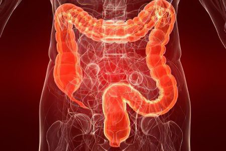 Causes and symptoms of acute and chronic intestinal colitis