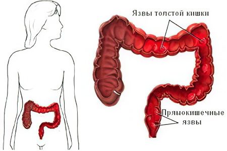 Causes and symptoms of acute and chronic intestinal colitis