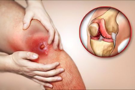 Causes and symptoms of acute and chronic osteomyelitis