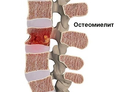 Causes and symptoms of acute and chronic osteomyelitis