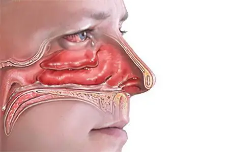 Causes and symptoms of adenoids in the nose