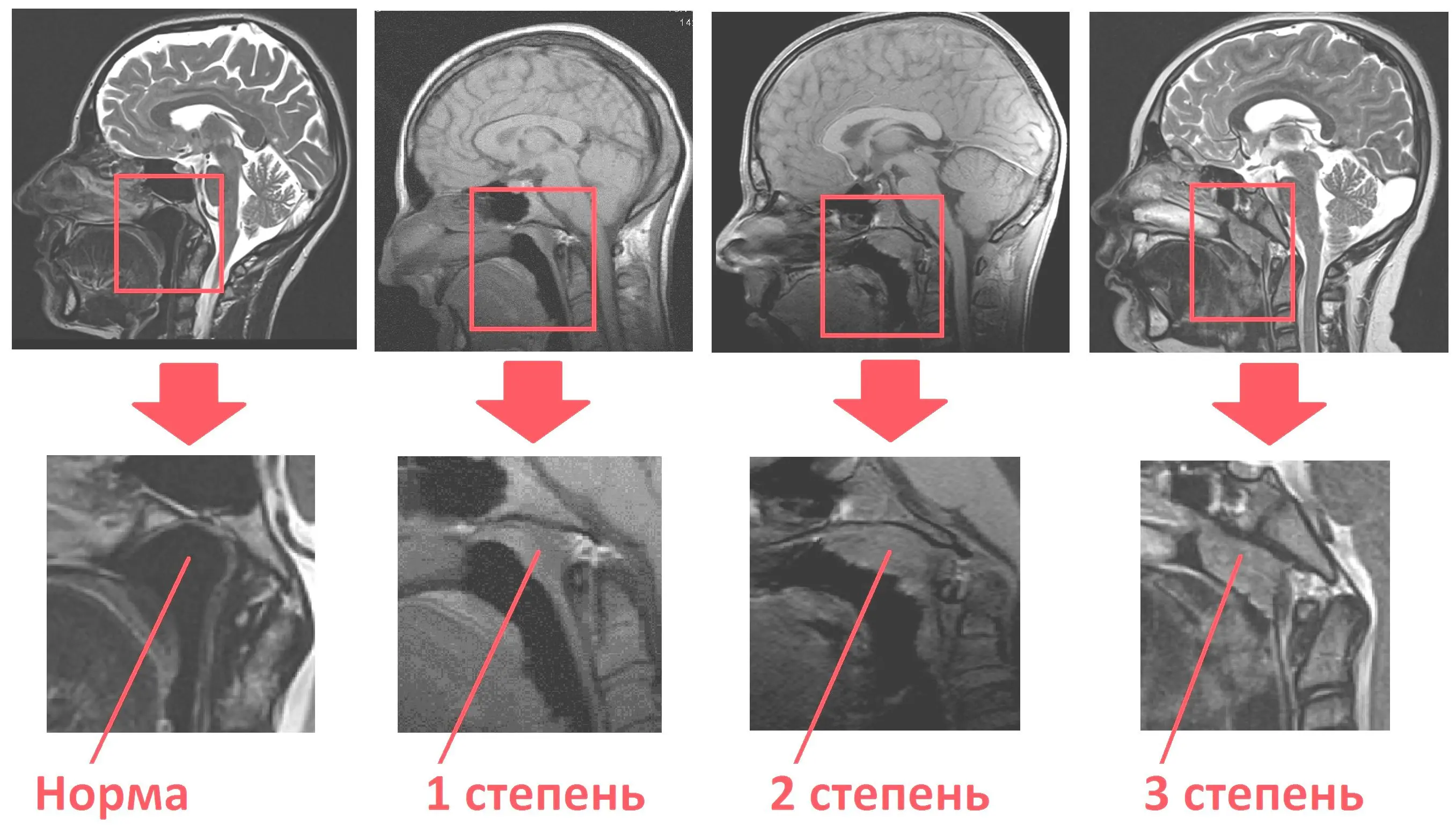 Causes and symptoms of adenoids in the nose