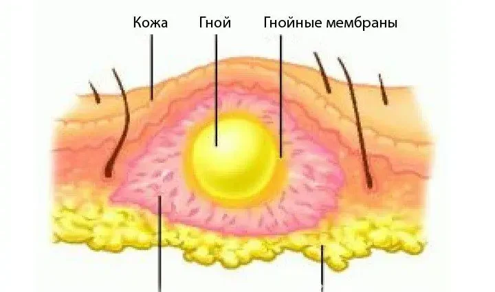 Causes and symptoms of an abscess