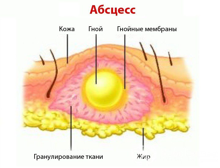 Causes and symptoms of an abscess