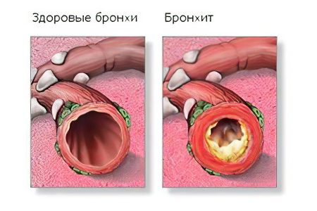 Causes and symptoms of bronchitis