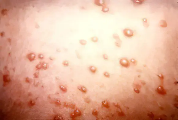 Causes and symptoms of chickenpox