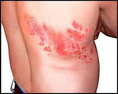 Causes and symptoms of chickenpox