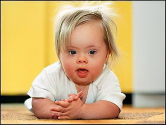 Causes and symptoms of down syndrome