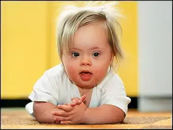 Causes and symptoms of down syndrome