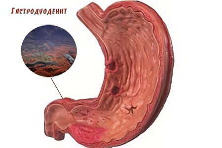 Causes and symptoms of gastroduodenitis