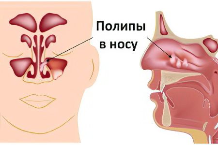 Causes and symptoms of polyps