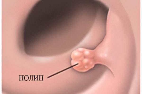 Causes and symptoms of polyps