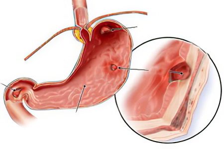 Causes and symptoms of polyps