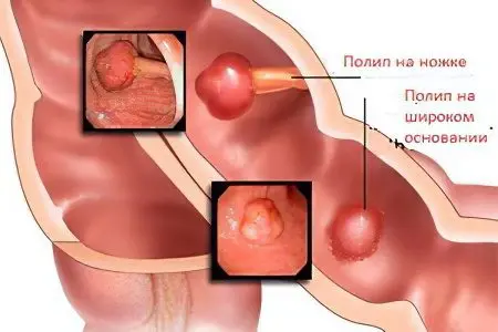 Causes and symptoms of polyps