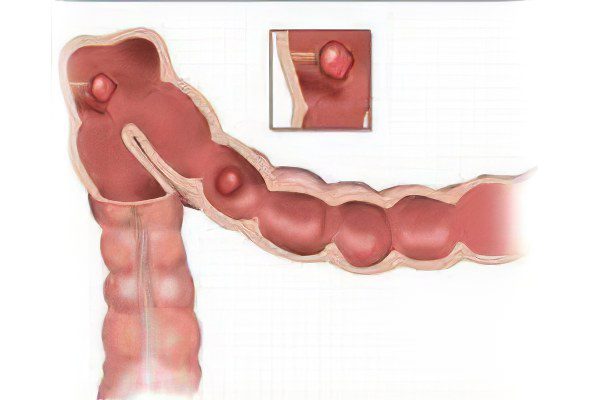 Causes and symptoms of polyps in the intestines, treatment and removal