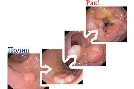 Causes and symptoms of polyps in the intestines, treatment and removal