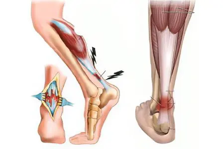 Causes and symptoms of tendovaginitis of the ankle joint