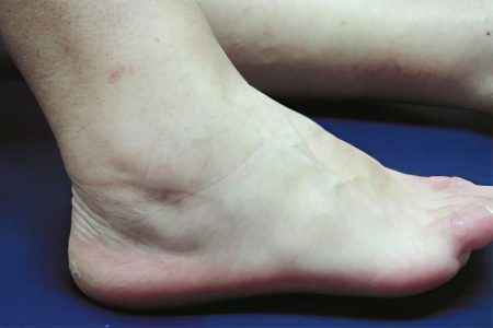 Causes and symptoms of tendovaginitis of the ankle joint