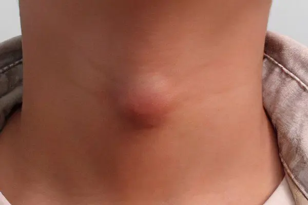 Causes and symptoms of thyroid cysts