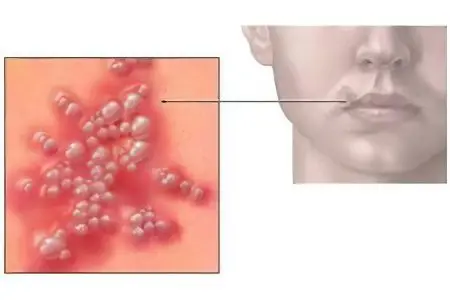 Causes and treatment of herpes on the lips in children and adults