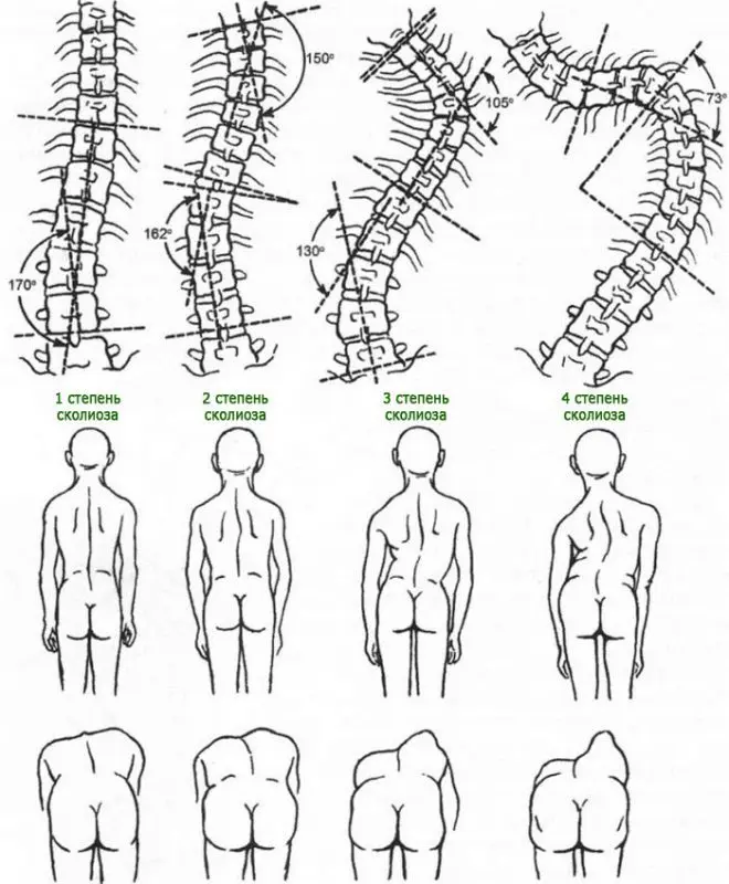 Causes and treatment of scoliosis of the spine