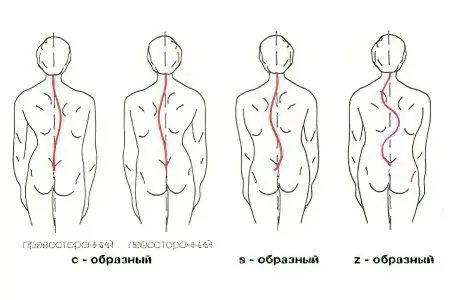 Causes and treatment of scoliosis of the spine