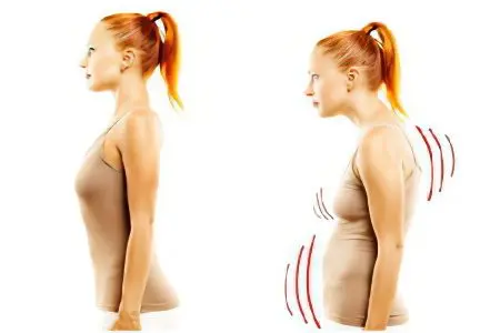 Causes and treatment of scoliosis of the spine