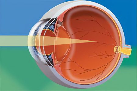 Causes, degrees and methods of improving vision in myopia