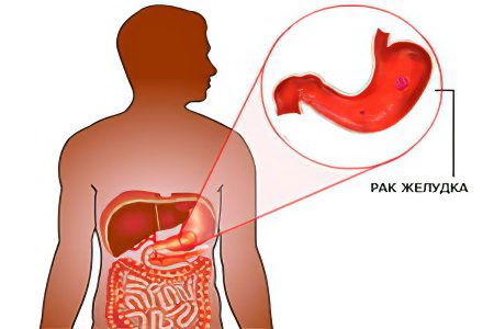 Causes, forms and symptoms of Helicobacter pylori