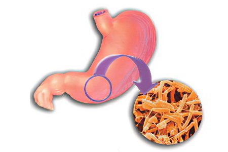 Causes, forms and symptoms of Helicobacter pylori