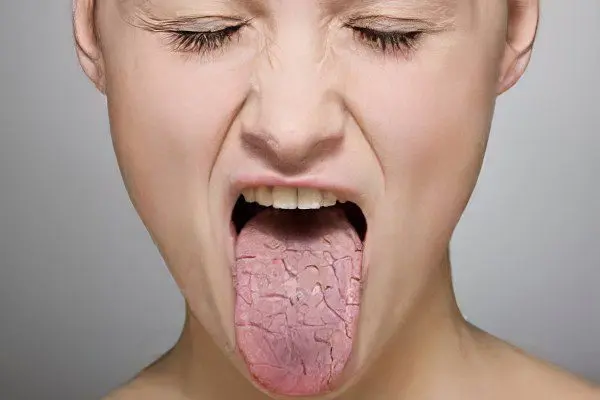 Causes of dry mouth