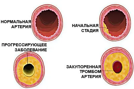 Causes of high cholesterol, what to do, how to treat?