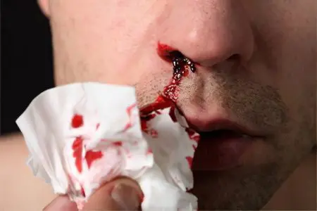 Causes of nosebleeds, first aid and treatment