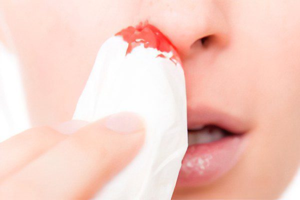 Causes of nosebleeds, first aid and treatment