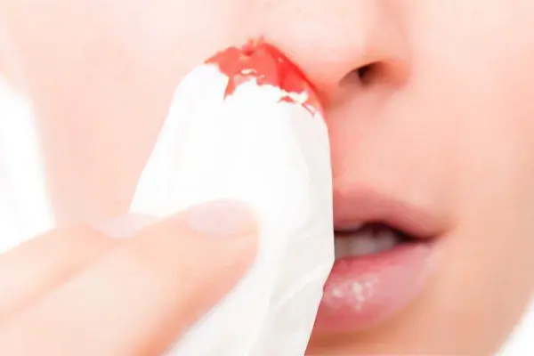 Causes of nosebleeds, first aid and treatment