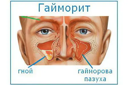 Causes, signs and symptoms of sinusitis